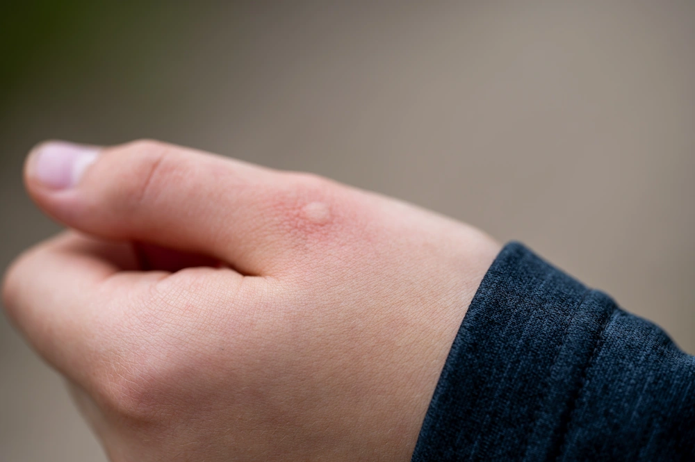 mosquito doctor How Do Mosquitoes Transmit Diseases?